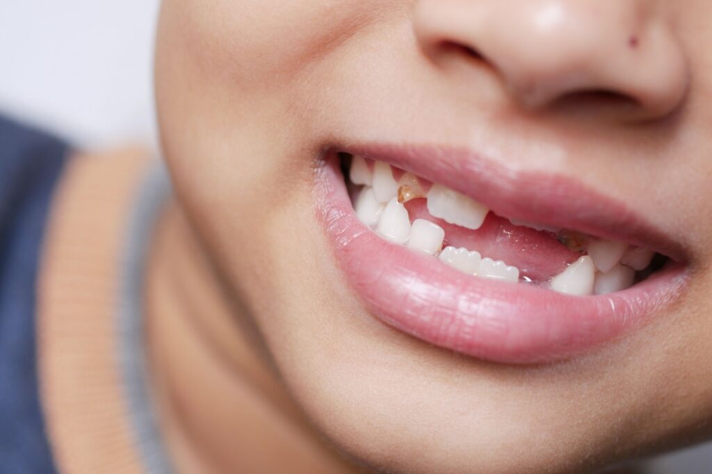 dental cleaning